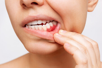 Gum Health – How Hormonal Fluctuations Can Affect Your Gum Health